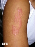 contact dermatitis