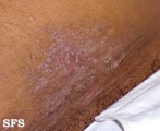 contact dermatitis