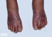 contact dermatitis
