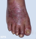 contact dermatitis