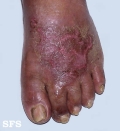contact dermatitis