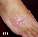contact dermatitis