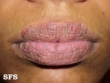 contact dermatitis