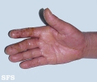 contact dermatitis