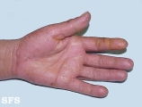 contact dermatitis