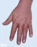 contact dermatitis