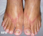 contact dermatitis
