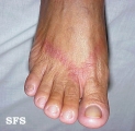 contact dermatitis