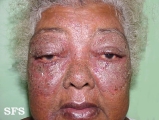 contact dermatitis