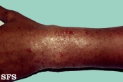 contact dermatitis