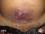 contact dermatitis