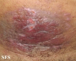 contact dermatitis