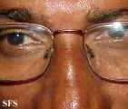 contact dermatitis