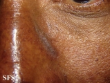 contact dermatitis