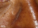 contact dermatitis