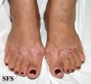 contact dermatitis