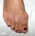 contact dermatitis