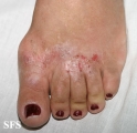 contact dermatitis