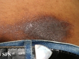 contact dermatitis