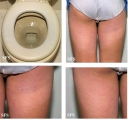 contact dermatitis