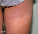 contact dermatitis