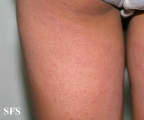 contact dermatitis
