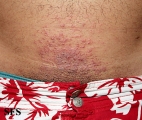 contact dermatitis