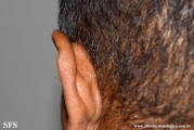 kimura_disease