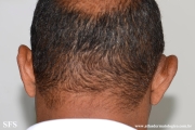 kimura_disease