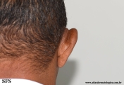 kimura_disease