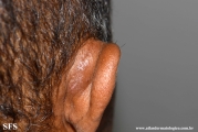 kimura_disease