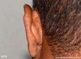 kimura_disease
