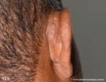 kimura_disease
