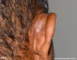 kimura_disease
