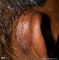 kimura_disease