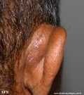 kimura_disease