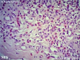 kimura_disease