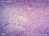 kimura_disease