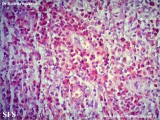 kimura_disease