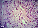 kimura_disease