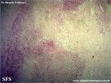 kimura_disease