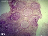 kimura_disease