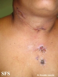 scrofuloderma