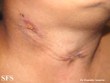 scrofuloderma