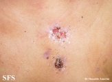 scrofuloderma