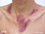 scrofuloderma