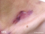 scrofuloderma