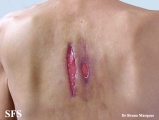 scrofuloderma