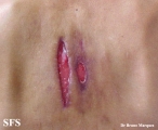 scrofuloderma