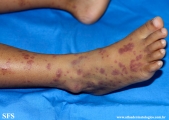 henoch-shönlein_purpura-iga_vasculite